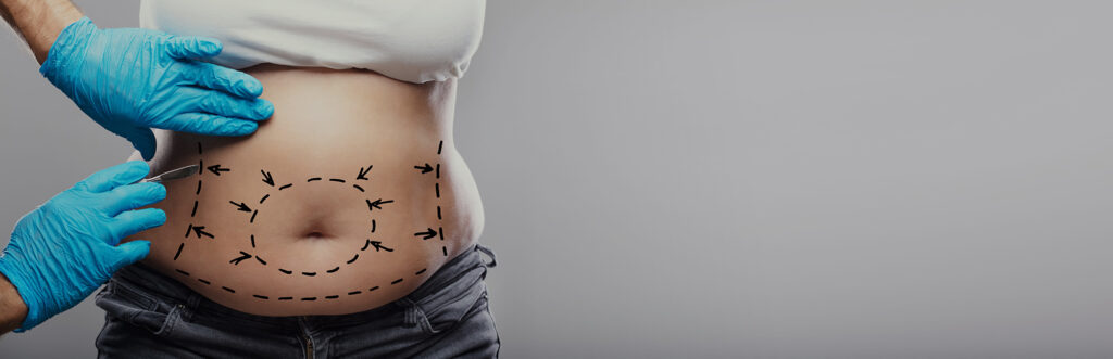 Liposuccion du ventre, bras, cuisses et hanches en Algérie à Constantine